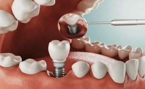 A Dental Implant 